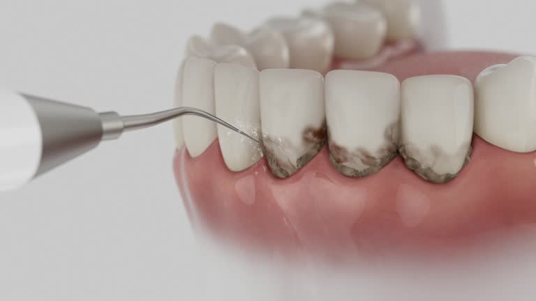 Trusted Wisdom Tooth Removal service in Roebling, NJ - Dentist Open Now